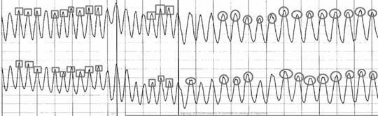 Polygraph Chart Analysis